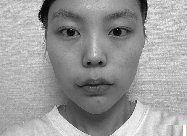 가슴 before 이미지